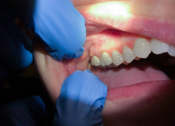 Best Tooth Infection Emergency Dentist  in Wmington, IL